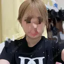 二重埋没 / 目頭切開 / 糸リフト / 脂肪吸引（顔） / ジョールファット除去 / ヒアルロン酸注入（あご） Wing clinic 豊中駅前院 AFTER サムネイル用