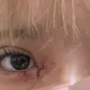 二重埋没 / 目頭切開 / 糸リフト / 脂肪吸引（顔） / ジョールファット除去 / ヒアルロン酸注入（あご） Wing clinic 豊中駅前院 DAY 89 サムネイル用