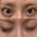 二重埋没 サラ美容外科 DAY 0 サムネイル用