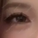 レーザートーニング（美白・肝斑） 渋谷美容外科クリニック 新橋院 DAY 0 サムネイル用