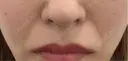 ヒアルロン酸注入（頬） / ボトックス（眉間） TCB東京中央美容外科 名古屋栄院 DAY 0 サムネイル用