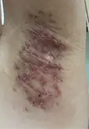 ワキ汗治療（切開） 石倉クリニック 水戸院 DAY 29 サムネイル用