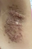 ワキ汗治療（切開） 石倉クリニック 水戸院 DAY 37 サムネイル用