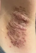 ワキ汗治療（切開） 石倉クリニック 水戸院 DAY 38 サムネイル用