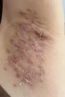 ワキ汗治療（切開） 石倉クリニック 水戸院 DAY 39 サムネイル用