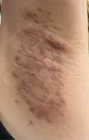 ワキ汗治療（切開） 石倉クリニック 水戸院 DAY 42 サムネイル用