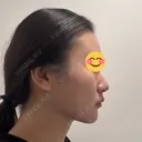 脂肪吸引（顔） / ヒアルロン酸注入（あご） HAAB×DREAM BEAUTY CLINIC 東京本院 DAY 47 サムネイル用