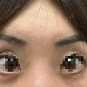 ボトックス（額） / その他（肌） 大美会クリニック 京都烏丸院 AFTER サムネイル用