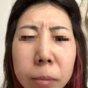 ボトックス（額） / その他（肌） 大美会クリニック 京都烏丸院 DAY 2 サムネイル用