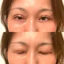 二重切開 水の森美容クリニック 大阪梅田院 DAY 9 サムネイル用