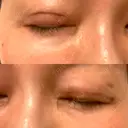 二重切開 水の森美容クリニック 大阪梅田院 DAY 9 サムネイル用