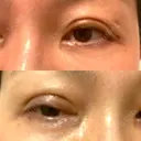 二重切開 水の森美容クリニック 大阪梅田院 DAY 9 サムネイル用