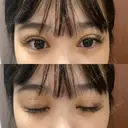 二重埋没 / RF（高周波）たるみ治療 Wing clinic 豊中駅前院 DAY 10 サムネイル用