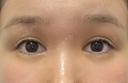 その他（目元） / 下まぶたたるみ取り OMI CLINIC 【オミクリニック】 DAY 17 サムネイル用