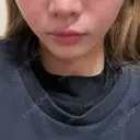 その他（輪郭） ルラ美容クリニック 沖縄院 DAY 1 サムネイル用