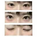 自然癒着法 / 眼瞼下垂（非切開） LUHO（ルホ）美容外科 AFTER サムネイル用