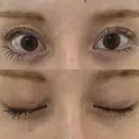 二重埋没 サラ美容外科 AFTER サムネイル用