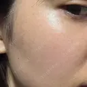 ピコスポット ビューティー和心クリニック 浅草院 AFTER サムネイル用