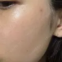 ピコスポット ビューティー和心クリニック 浅草院 DAY 7 サムネイル用