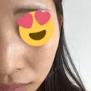 ピーリング（ハリ・ツヤ） / ルメッカ PureMe Skin Clinic（ピュアミースキンクリニック麻布） AFTER サムネイル用