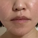 鼻翼基部形成（貴族手術） / ヒアルロン酸注入（鼻） / ボトックス（口角） / ボトックス（人中） eクリニック 名古屋院 AFTER サムネイル用