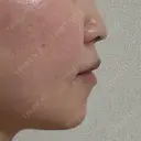 鼻翼基部形成（貴族手術） / ヒアルロン酸注入（鼻） / ボトックス（口角） / ボトックス（人中） eクリニック 名古屋院 DAY 93 サムネイル用