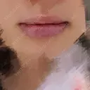 口唇縮小術 Kono Clinic DAY 9 サムネイル用