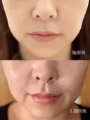 脂肪溶解注射（顔） / ボトックス（口角） / ボトックス（眉間） / ボトックス（額） / その他（肌） ルラ美容クリニック 仙台院 / ルラスキンクリニック 仙台院 AFTER サムネイル用