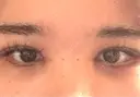 二重埋没 / 目頭切開 / 目尻切開 / 上まぶたの脂肪取り / タレ目形成・グラマラスライン（切開） / 目尻靭帯移動 / 自然癒着法 / 眼瞼下垂（非切開） / ヒアルロン酸注入（唇） / ボトックス（人中） / ヒアルロン酸注入（鼻翼基部） BITO BEAUTY CLINIC DAY 21 サムネイル用