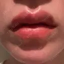 ヒアルロン酸注入（唇） AZ BEAUTY CLINIC DAY 1 サムネイル用