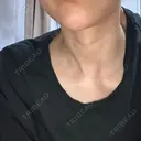 肌ヒアルロン酸注入（たるみ・シワ改善） / ピコレーザートーニング（美白・肝斑） 渋谷美容外科クリニック 横浜院 AFTER サムネイル用