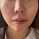 ボトックス（あご） / ボトックス（目尻） / ボトックス（額） 代々木駅前美容クリニック DAY 1 サムネイル用