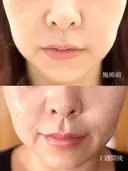 脂肪溶解注射（顔） / ボトックス（口角） / ボトックス（眉間） / ボトックス（額） / その他（肌） ルラ美容クリニック 仙台院 / ルラスキンクリニック 仙台院 DAY 0 サムネイル用