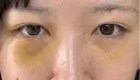 クマ治療 / 下まぶたたるみ取り / 下まぶたの脂肪取り APOLLO BEAUTY CLINIC DAY 4 サムネイル用
