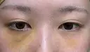 クマ治療 / 下まぶたたるみ取り / 下まぶたの脂肪取り APOLLO BEAUTY CLINIC DAY 5 サムネイル用
