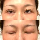 二重切開 水の森美容クリニック 大阪梅田院 DAY 15 サムネイル用