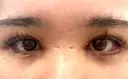 二重埋没 / 目頭切開 / 目尻切開 / 上まぶたの脂肪取り / タレ目形成・グラマラスライン（切開） / 目尻靭帯移動 / 自然癒着法 / 眼瞼下垂（非切開） / ヒアルロン酸注入（唇） / ボトックス（人中） / ヒアルロン酸注入（鼻翼基部） BITO BEAUTY CLINIC DAY 23 サムネイル用