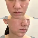 毛穴洗浄（ハイドラフェイシャルなど） / ポテンツァ ルラ美容クリニック 京都院 DAY 0 サムネイル用