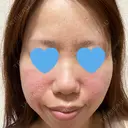 ボトックス（エラ・小顔） / ヒアルロン酸注入（鼻翼基部） 目白ホワイトクリニック DAY 0 サムネイル用