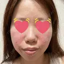 ボトックス（エラ・小顔） / ヒアルロン酸注入（鼻翼基部） 目白ホワイトクリニック DAY 1 サムネイル用
