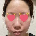 ボトックス（エラ・小顔） / ヒアルロン酸注入（鼻翼基部） 目白ホワイトクリニック AFTER サムネイル用