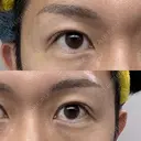 二重埋没 けやき美容クリニック 沼津院 AFTER サムネイル用