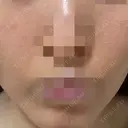 ニードルRF（ポテンツァなど） ながしま形成外科クリニック AFTER サムネイル用