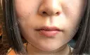 糸リフト / バッカルファット除去 / ボトックス（エラ・小顔） / ヒアルロン酸注入（頬） / フラクショナルレーザー（毛穴・ニキビ跡） TCB東京中央美容外科 仙台駅前院 DAY 18 サムネイル用