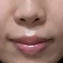 ヒアルロン酸注入（涙袋） / ヒアルロン酸注入（唇） / ヒアルロン酸注入（鼻翼基部） 小倉美容外科/美容皮膚科 ビラビューティークリニック DAY 2 サムネイル用
