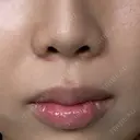 ヒアルロン酸注入（涙袋） / ヒアルロン酸注入（唇） / ヒアルロン酸注入（鼻翼基部） 小倉美容外科/美容皮膚科 ビラビューティークリニック DAY 12 サムネイル用