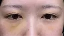 クマ治療 / 下まぶたたるみ取り / 下まぶたの脂肪取り APOLLO BEAUTY CLINIC DAY 6 サムネイル用