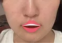 脂肪吸引（顔） 湘南美容クリニック 渋谷院 DAY 50 サムネイル用