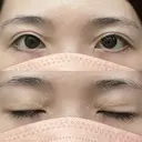 目尻切開 / タレ目形成・グラマラスライン（切開） 銀座高須クリニック AFTER サムネイル用