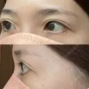 目尻切開 / タレ目形成・グラマラスライン（切開） 銀座高須クリニック DAY 379 サムネイル用